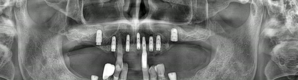 수술 후 위턱. 앞뒤로 임플란트가 서 있고, 그 위에는 아직 아무것도 올리지 않은 상태.
