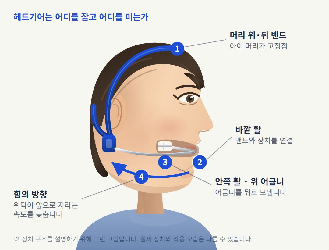 헤드기어가 어디를 잡고 어디를 미는지 그린 그림입니다. 머리가 고정점이 되고, 바깥 활과 안쪽 활을 통해 위 어금니가 뒤로 이동합니다.