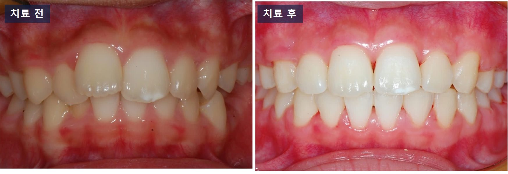 교정 케이스 · 헤드기어 교정, 위 앞니가 나온 아이는 언제 시작할까? 치료 전후 사진