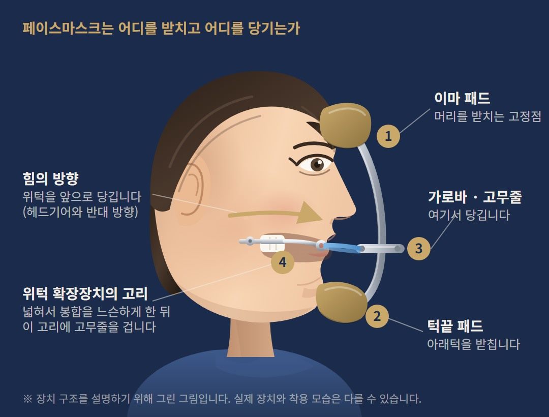 페이스마스크가 어디를 받치고 어디를 당기는지 그린 그림입니다. 이마와 턱끝이 받침이 되고, 입 안 확장장치의 고리에 건 고무줄이 위턱을 앞으로 당깁니다.