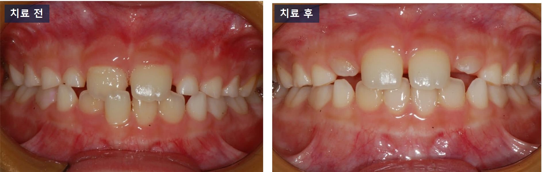 교정 케이스 · 끼웠다 뺐다 하는 장치로도 되는 경우 치료 전후 사진