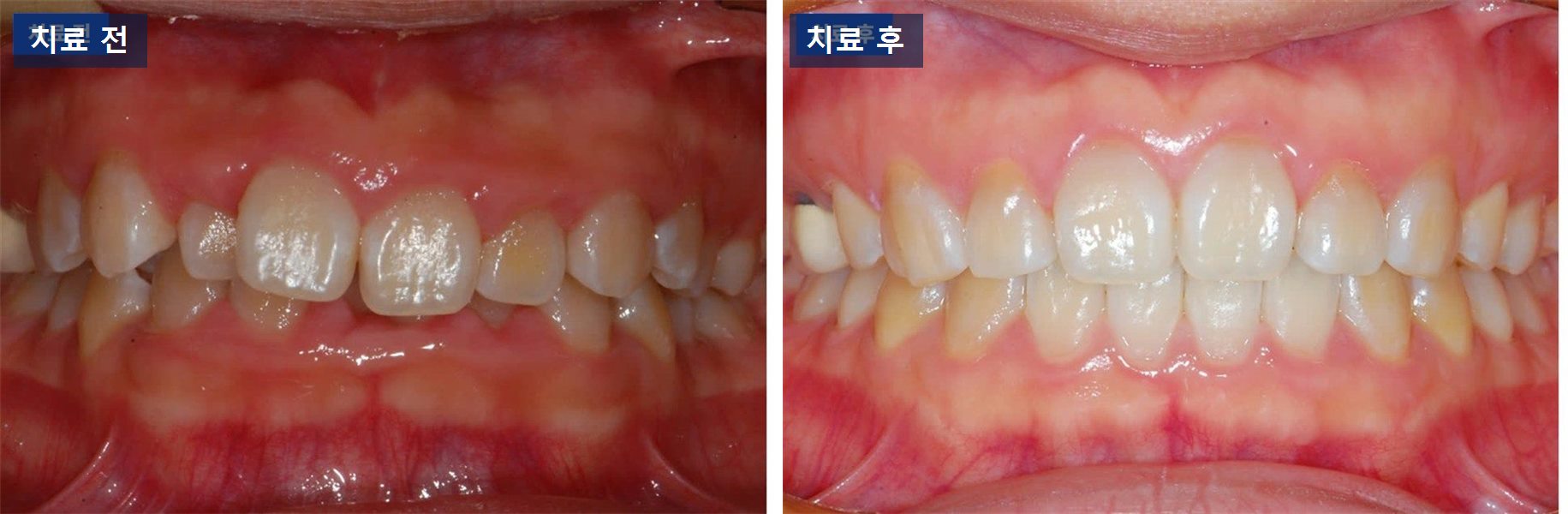 교정 케이스 · 앞니 교정만으로는 안 되는 윗니 덮임, 성장기엔 이렇게 풉니다 치료 전후 사진