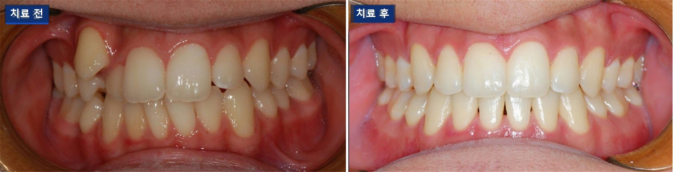 교정 케이스 · 덧니 교정, 송곳니가 설 자리는 어떻게 만들까 치료 전후 사진