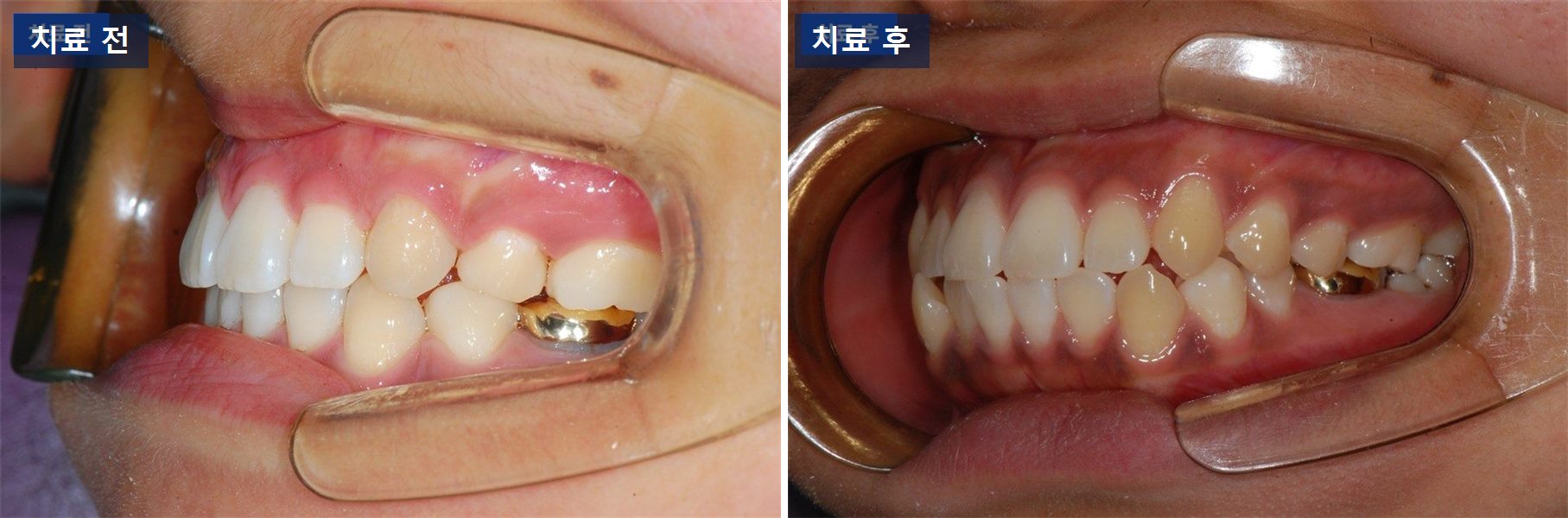 교정 케이스 · 돌출입 교정, 이를 뺄지 말지는 무엇으로 정할까 치료 전후 사진