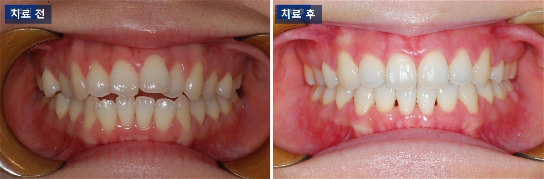 교정 케이스 · 돌출입, 같은 진단에 나이만 달랐던 두 분 치료 전후 사진