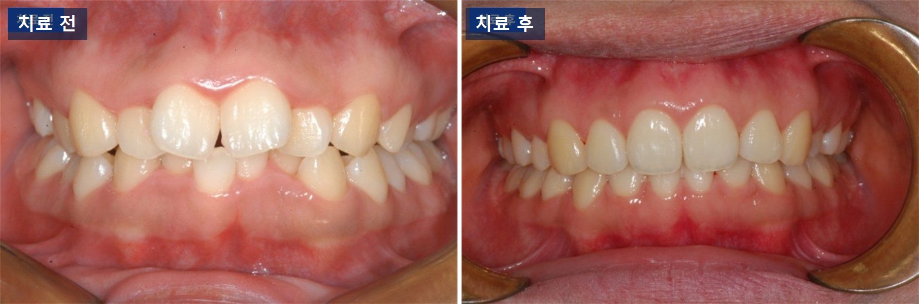 교정 케이스 · 거미스마일, 웃을 때 잇몸이 많이 보이는 이유 치료 전후 사진