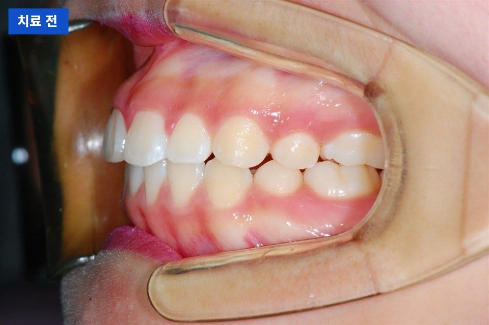 치료 전 옆에서 본 모습입니다. 앞니가 앞으로 기울어 있습니다. (개인차 있음)