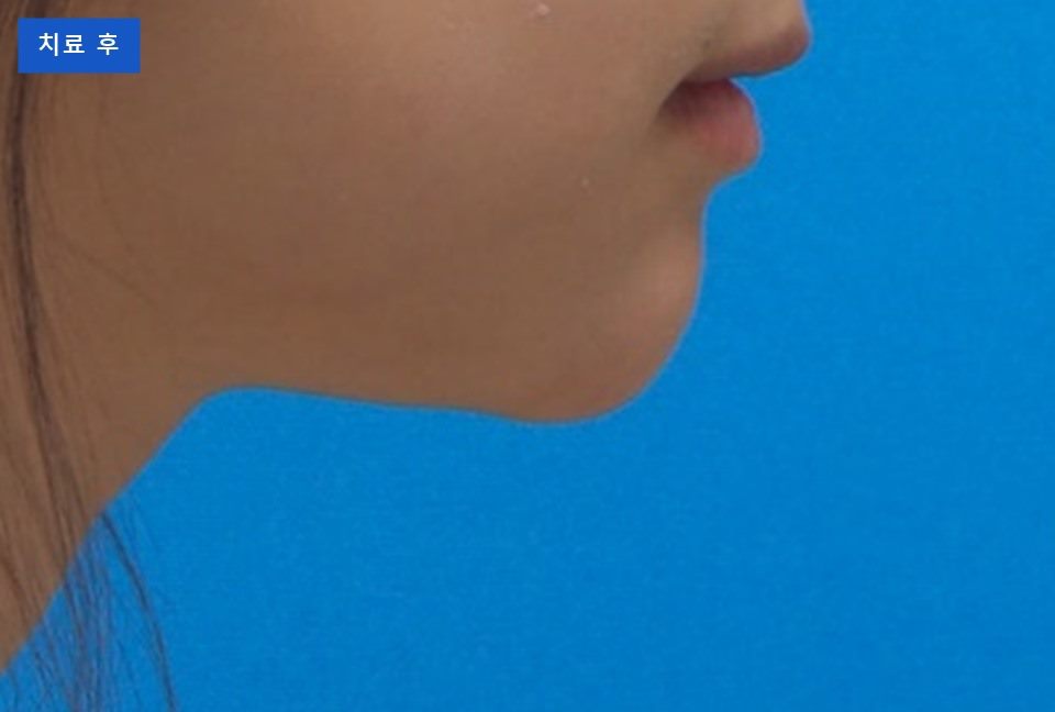 치료 후 옆얼굴을 코 아래만 담았습니다. 치료 전 사진과 입술·턱 끝 모습을 견주어 보실 수 있습니다. (개인차 있음)
