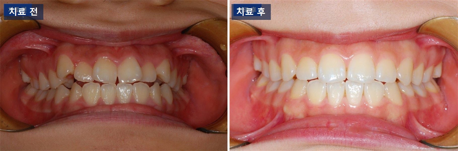 교정 케이스 · 발치교정, 뺀 자리를 닫는 데 걸린 1년 치료 전후 사진