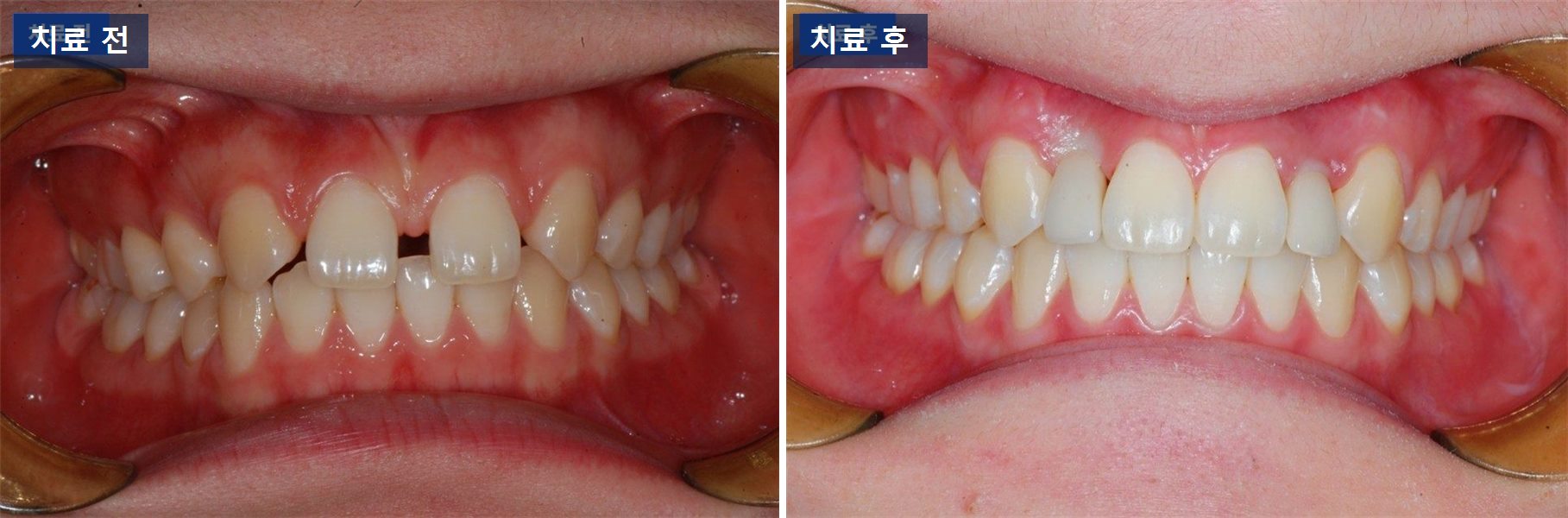 교정 케이스 · 치아교정으로 임플란트 자리를 만든다는 말의 뜻 치료 전후 사진