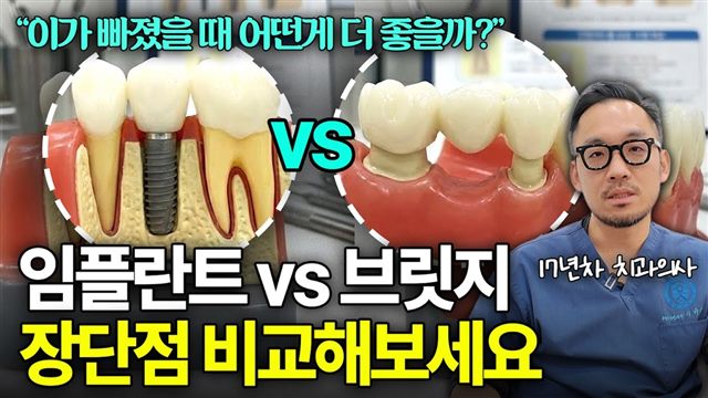 이바다이야기 영상: 임플란트? 브릿지? 장단점 비교