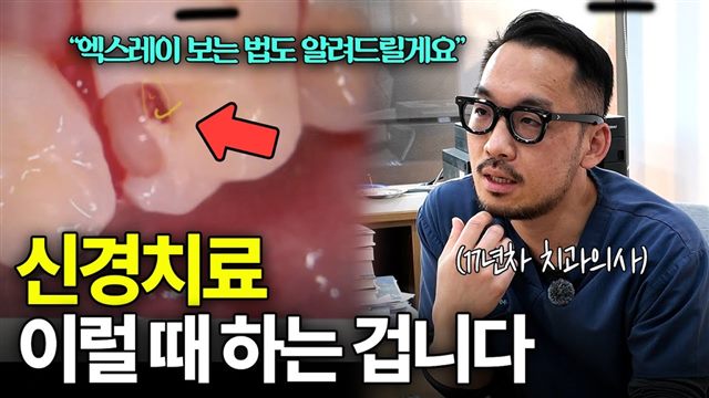 이바다이야기 영상: 엑스레이로 보는 신경치료가 필요한 치아 · 과잉진료 피하는 법
