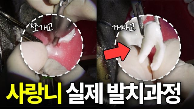 이바다이야기 영상: 매복 사랑니 발치 과정